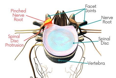 left l5 nerve root impingement